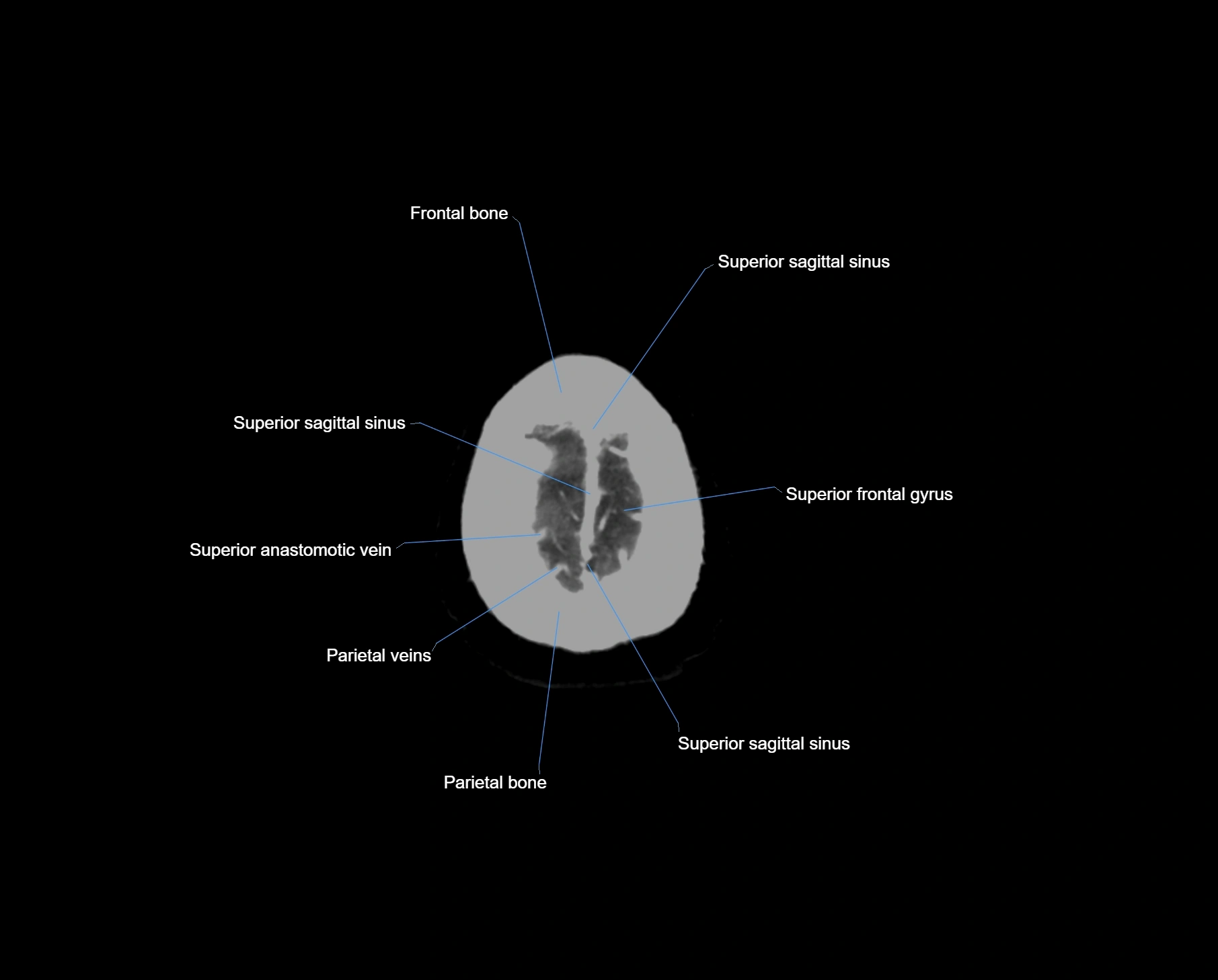 CT scan brain axial labelled cross sectional anatomy image-img-000070.webp